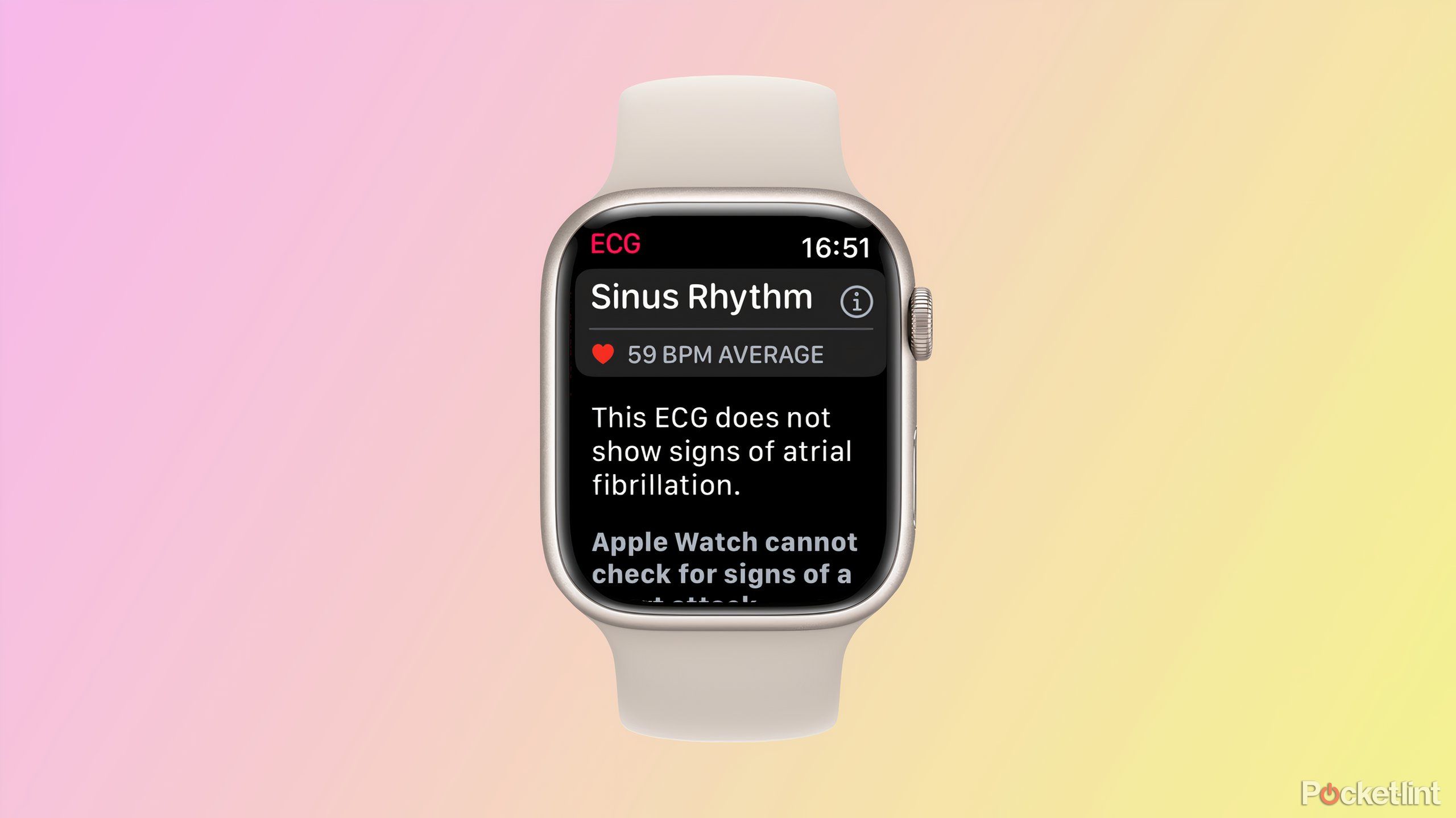 apple watch ecg sinus rhythm reading