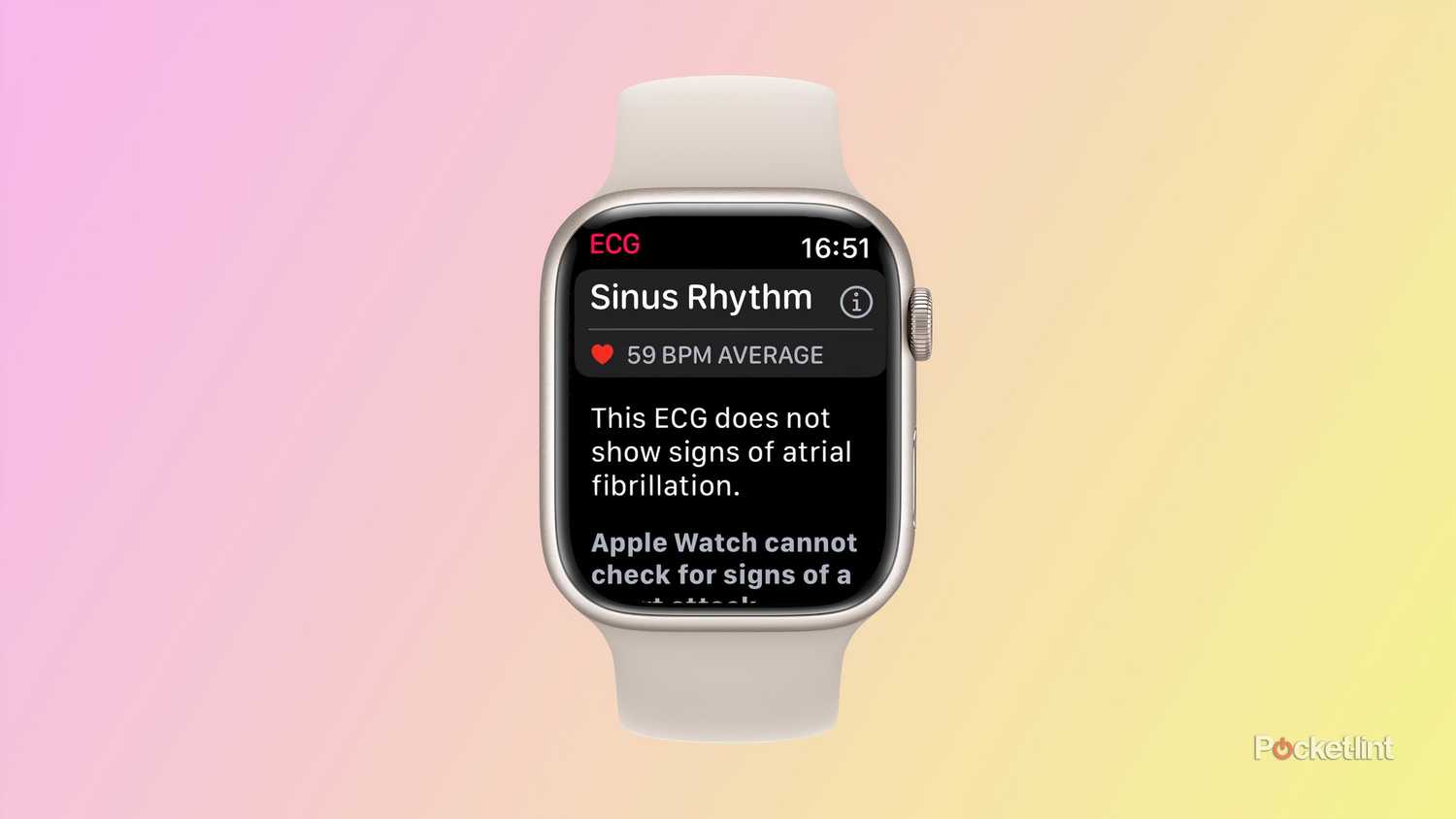 Sinus Rhythm Apple Ecg Accuracy Sinus Rhythm Apple Watch Sinus